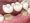 Dental,Bridge,Of,3,Teeth,Over,Molar,And,Premolar.,Medically