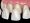 Veneer,Installation,Procedure,Over,Central,Incisor,And,Lateral,Incisor.,Medically